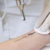 How Much Does Tattoo Removal Cost? Thumbnail