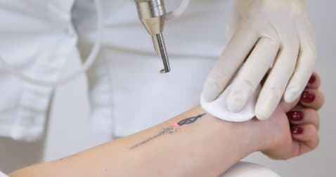 Thumbnail for Blog Article: How Much Does Tattoo Removal Cost?